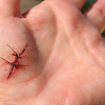 points de sutures et traitement de plaies
